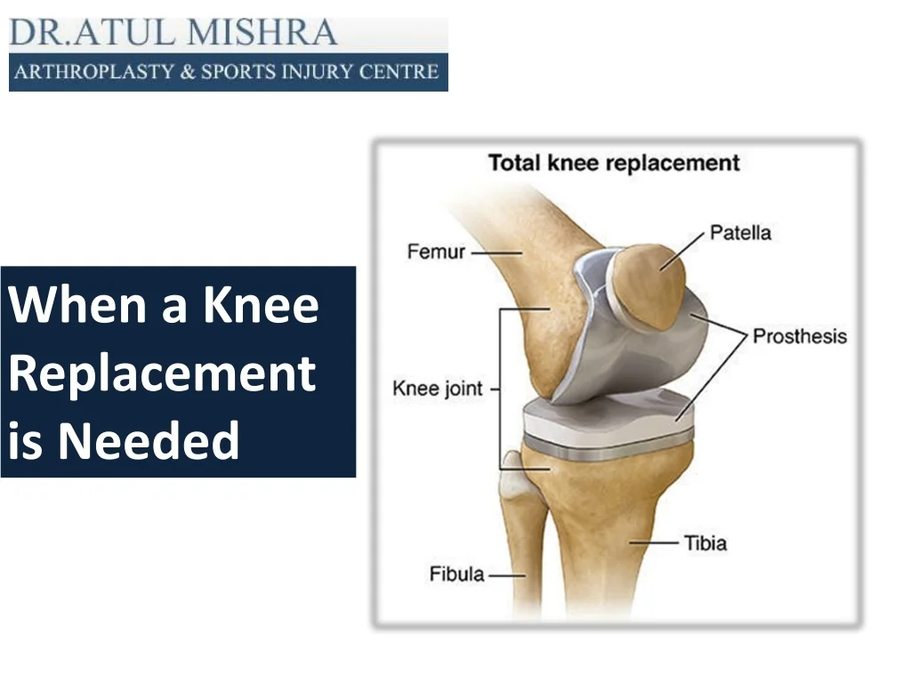 PPT - Best Knee Replacement Surgery in Delhi NCR, Total Knee surgeon ...