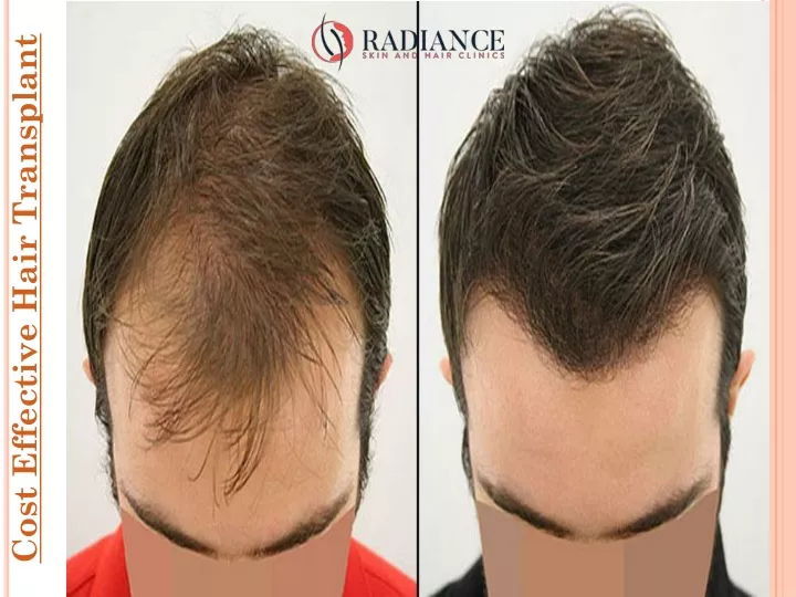cost effective hair transplant
