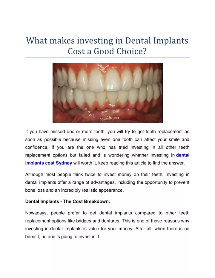 what makes investing in dental implants cost