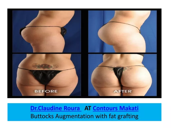 dr claudine roura at contours makati buttocks