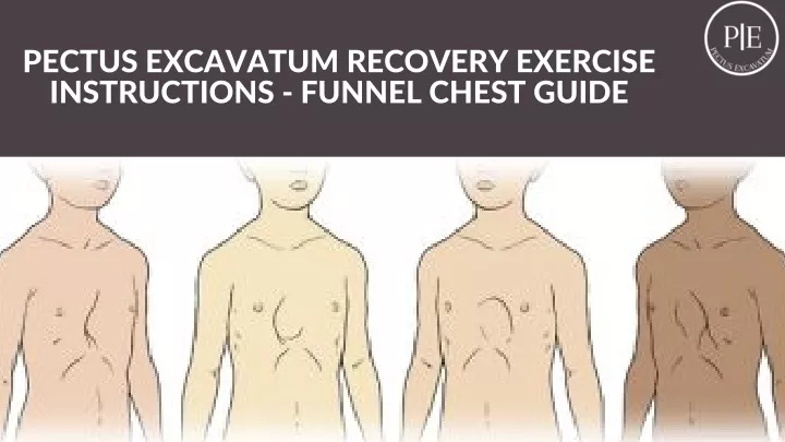 pectus excavatum recovery exercise instructions