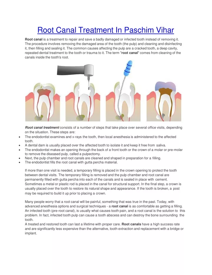 root canal treatment in paschim vihar