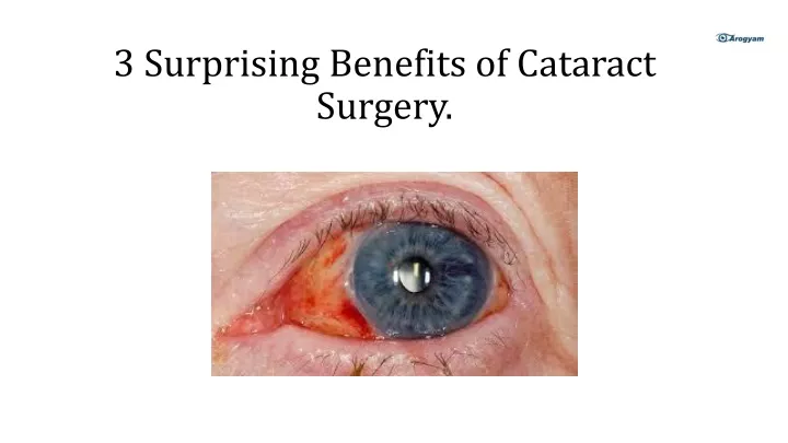 3 surprising benefits of cataract surgery
