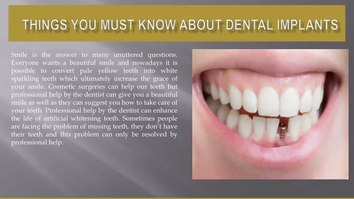 things you must know about dental implants