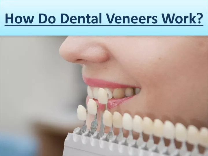 how do dental veneers work