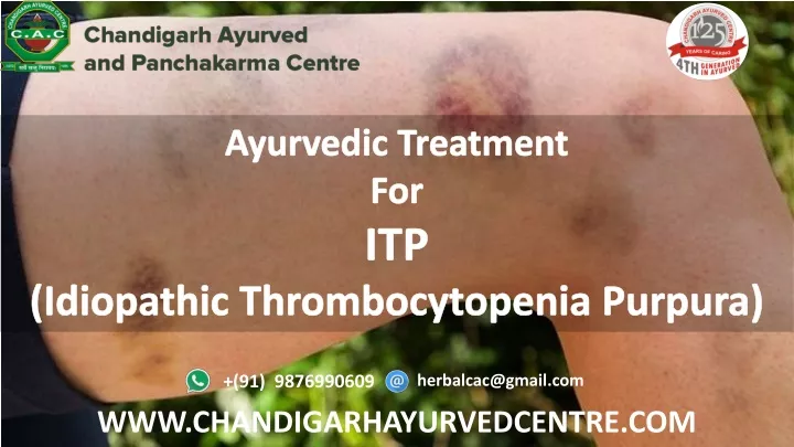 ayurvedic treatment for itp idiopathic