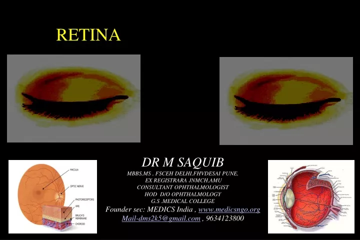 retina viral keratitis