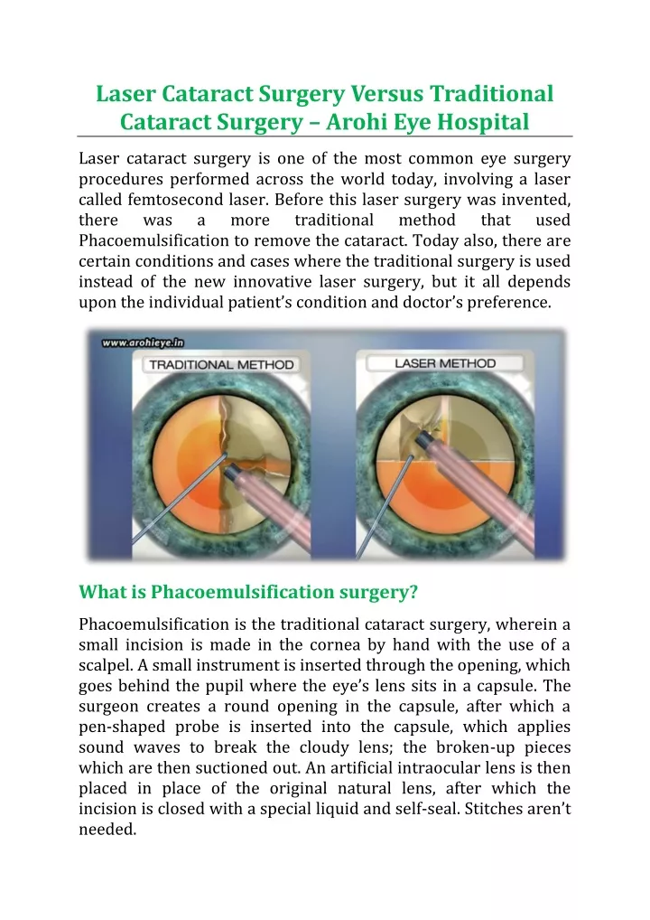 laser cataract surgery versus traditional