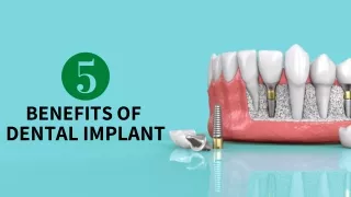 5 Benefits Of Dental Implant