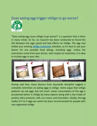 Does eating egg trigger vitiligo to go worse?