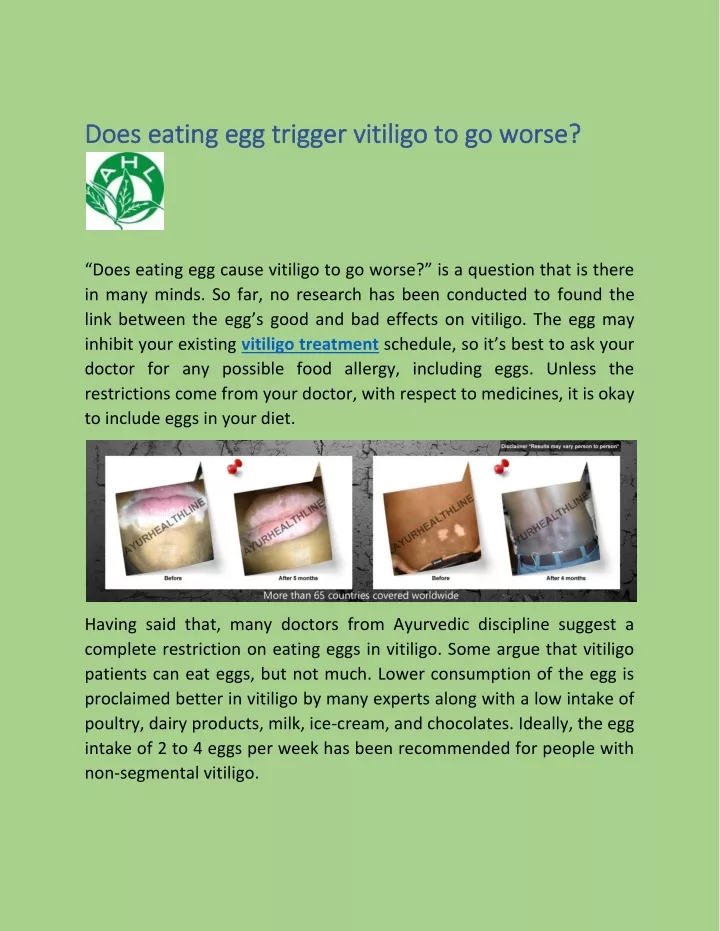 does eating egg trigger vitiligo to go worse does