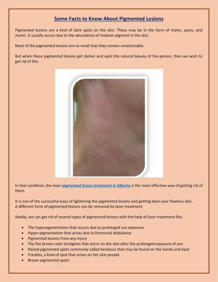 some facts to know about pigmented lesions