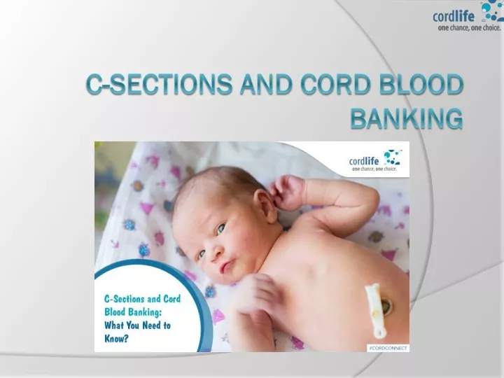 c sections and cord blood banking