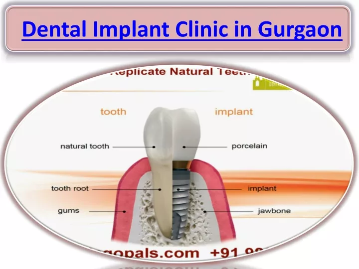 dental implant clinic in gurgaon