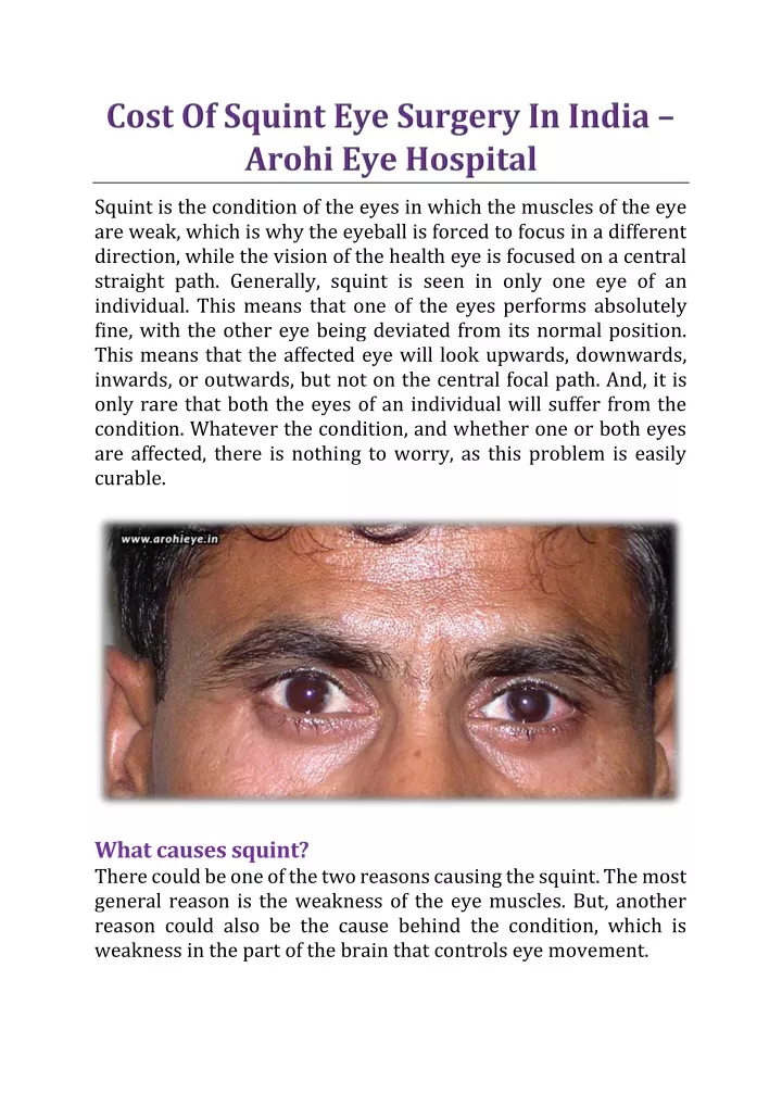 squint is the condition of the eyes in which