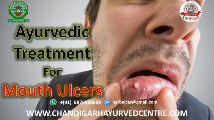 ayurvedic treatment for mouth ulcers