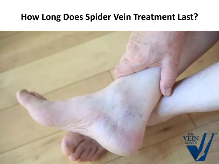 how long does spider vein treatment last