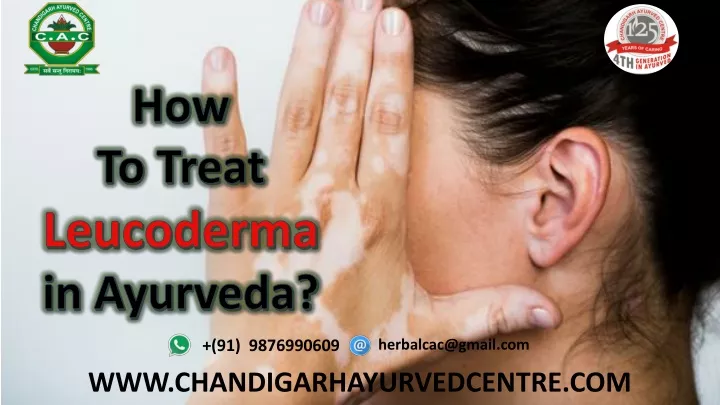 how to treat leucoderma in ayurveda