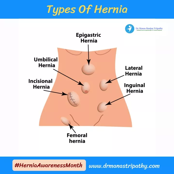 types of hernia