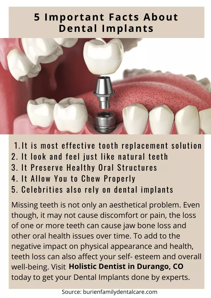 5 important facts about dental implants
