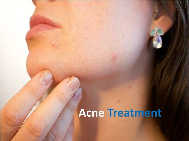 acne treatment