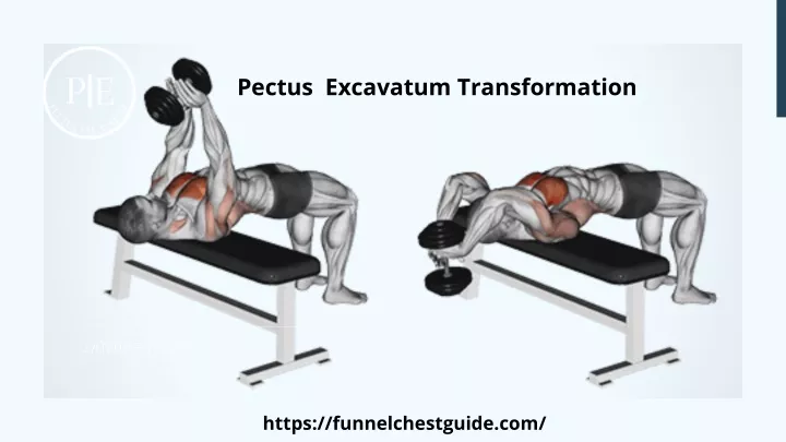 pectus excavatum transformation