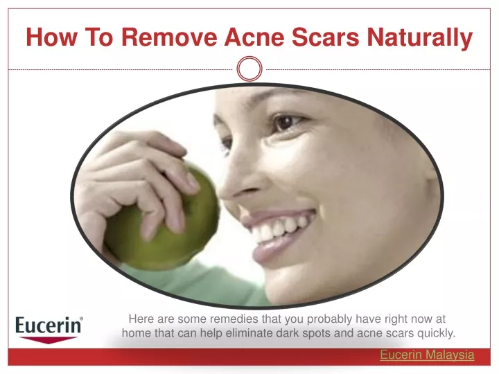 how to remove acne scars naturally