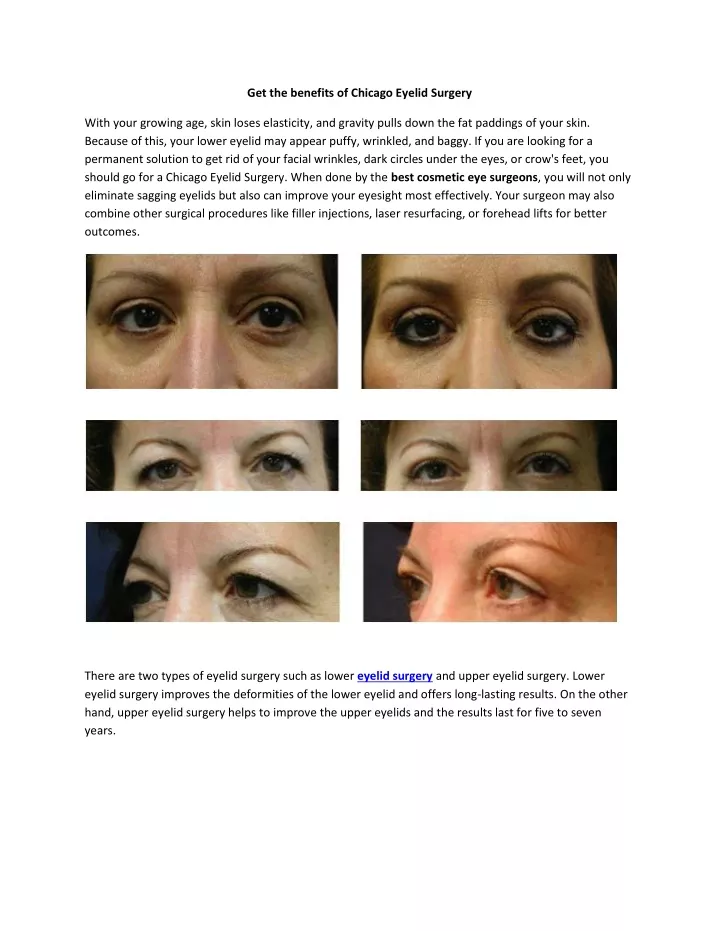 get the benefits of chicago eyelid surgery