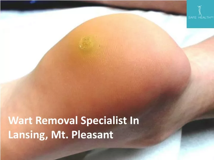 wart removal specialist in lansing mt pleasant