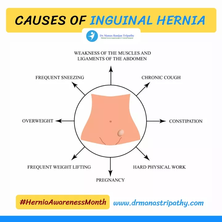 causes of inguinal hernia