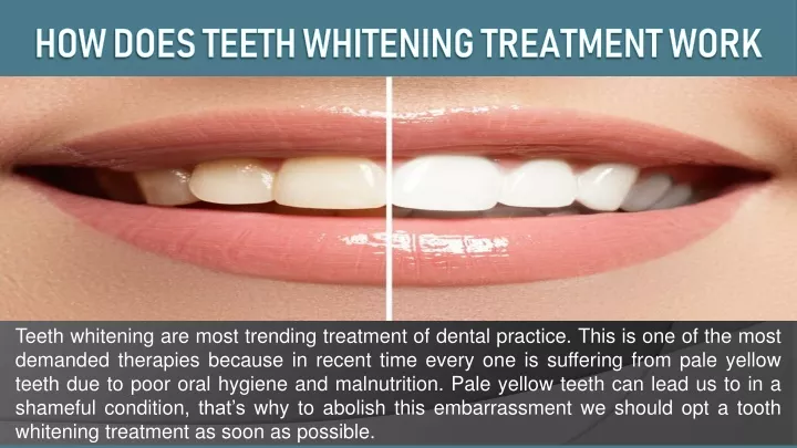 how does teeth whitening treatment work