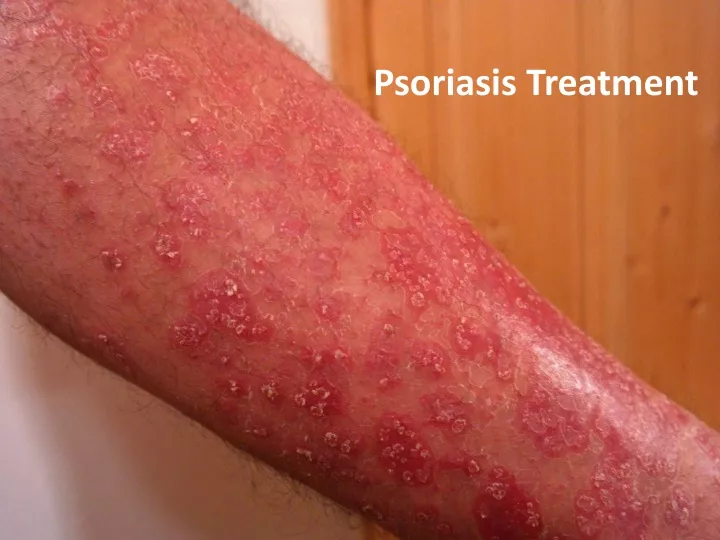 psoriasis treatment