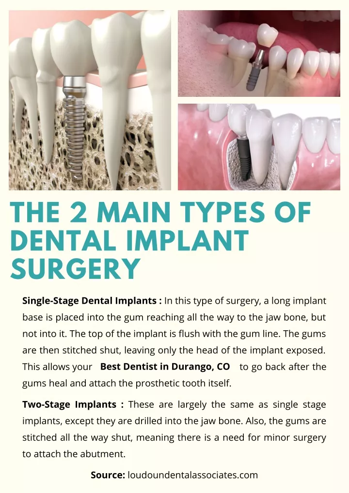 the 2 main types of dental implant surgery