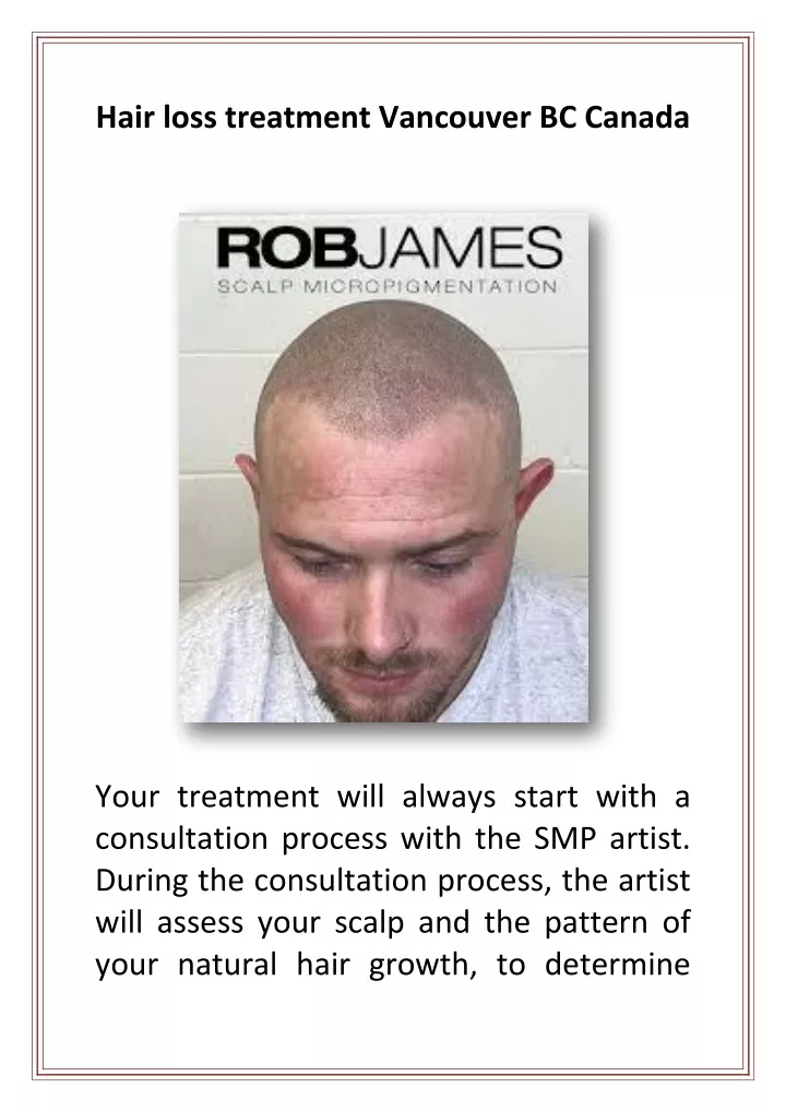 hair loss treatment vancouver bc canada