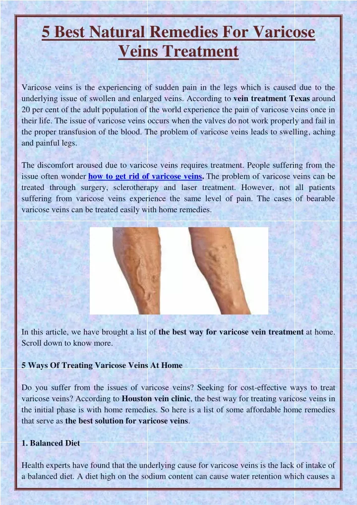5 best natural remedies for varicose veins