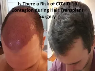 Is There a Risk of COVID-19 Contagion during Hair Transplant Surgery