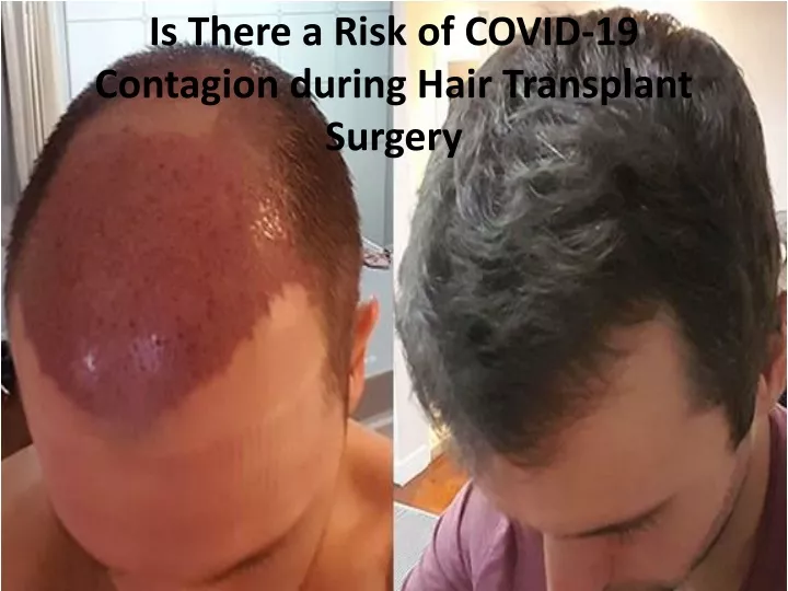 is there a risk of covid 19 contagion during hair transplant surgery