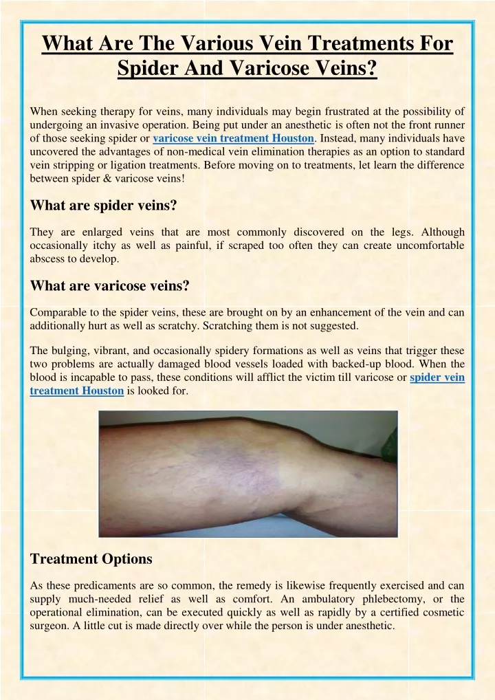 what are the various vein treatments for spider