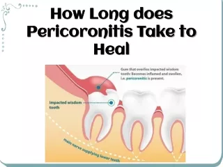 How Long Does Pericoronitis Take To Heal