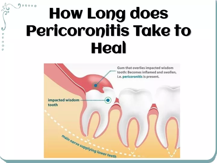 how long does pericoronitis take to heal