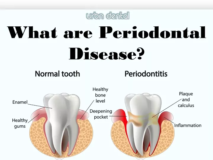 what are periodontal disease
