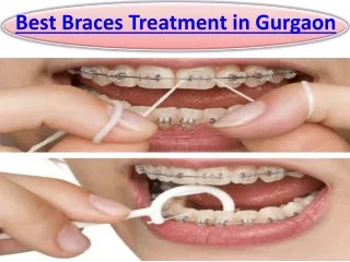 Top 5 Best Braces Treatment in Gurgaon and Orthodontist in Gurgaon