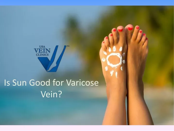 is sun good for varicose vein