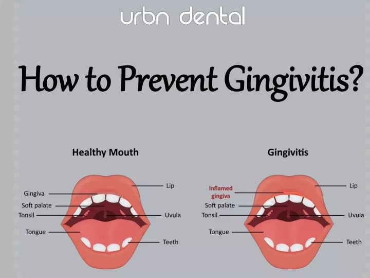 how to prevent gingivitis