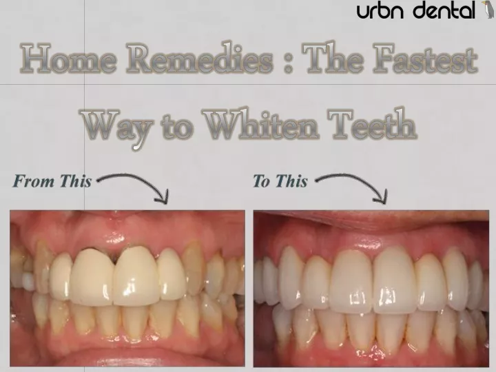 home remedies the fastest way to whiten teeth