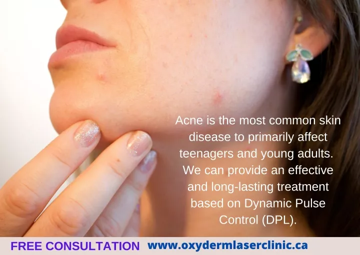 acne is the most common skin disease to primarily